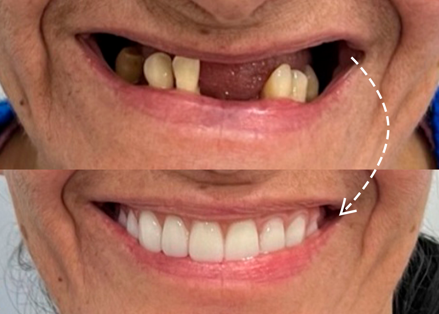 Caso clínico de reabilitação com implantes dentários